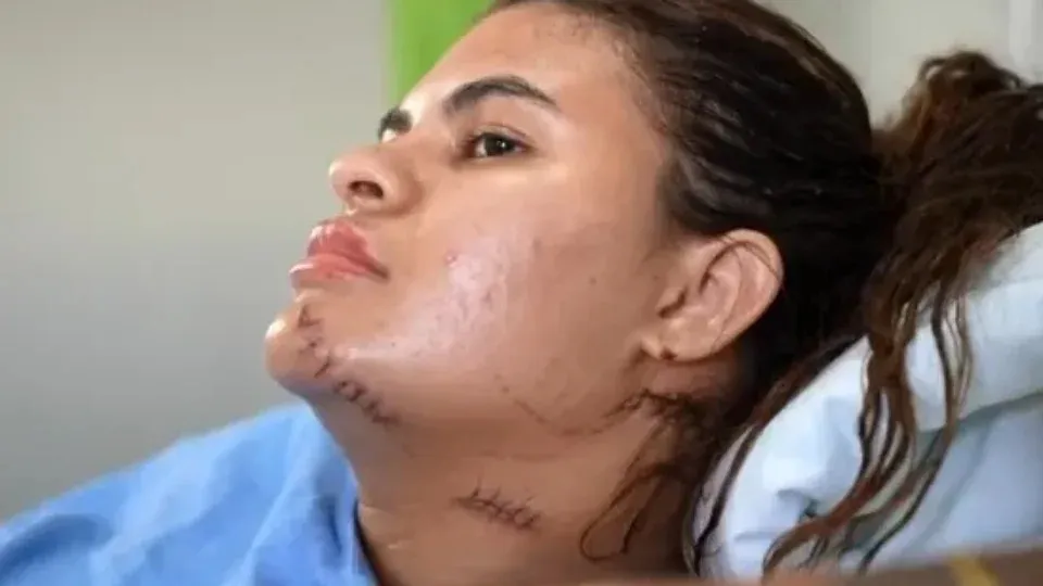 'Me fiz de morta', diz estudante que teve as mãos amputadas em ataque com foice no Ceará 1