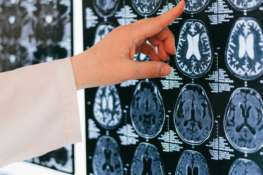 Doença de Alzheimer; O que você pode fazer agora?