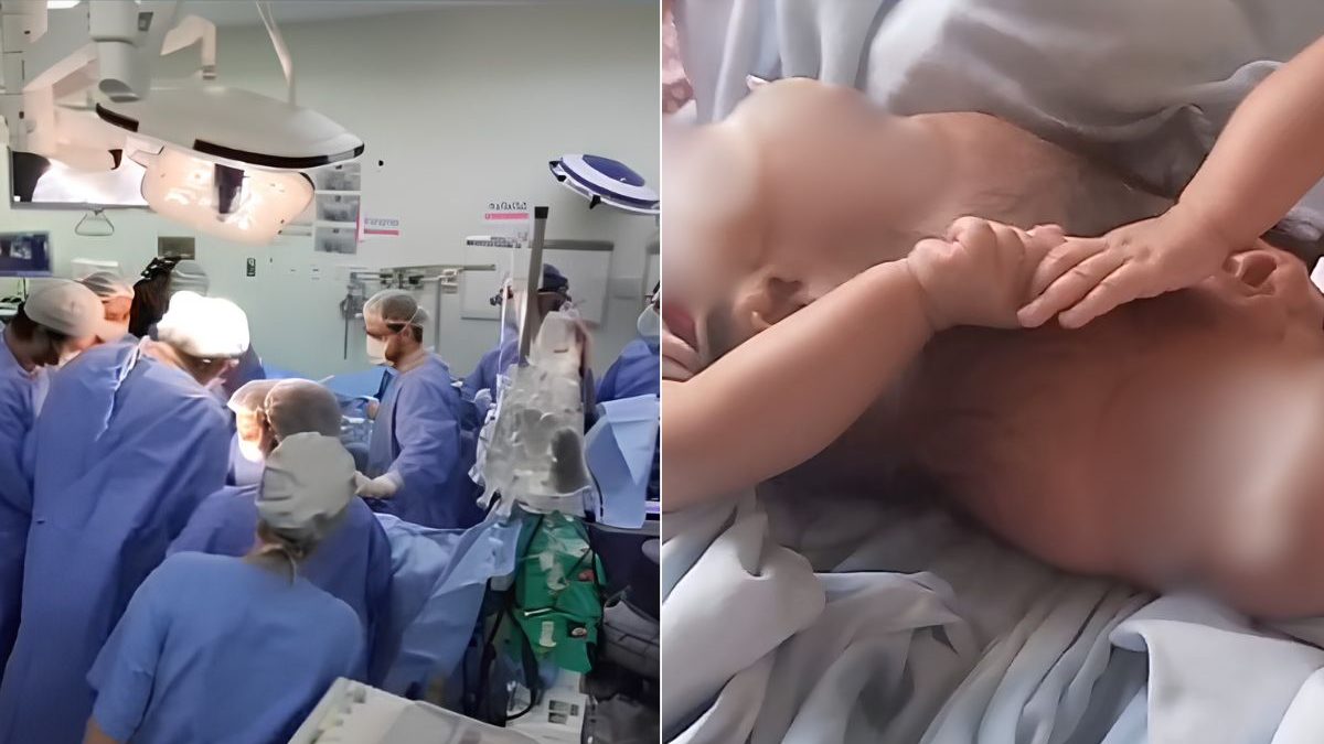 Após 15 horas de cirurgia, morrem gêmeas siamesas que nasceram unidas pela cabeça 27